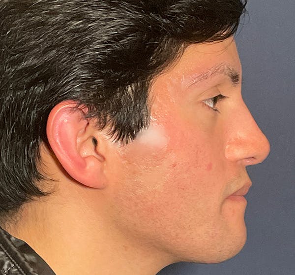  Liquid Rhinoplasty Before & After Gallery - Patient 145833089 - Image 8