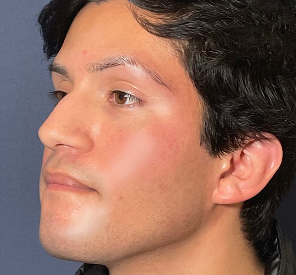  Liquid Rhinoplasty Before & After Gallery - Patient 145833089 - Image 9