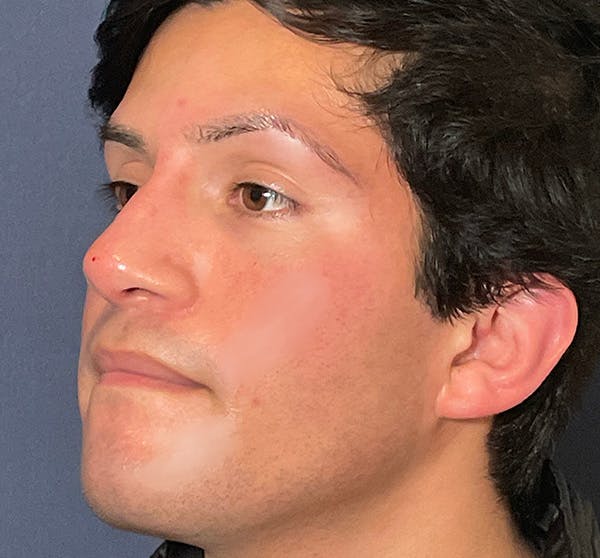  Liquid Rhinoplasty Before & After Gallery - Patient 145833089 - Image 10