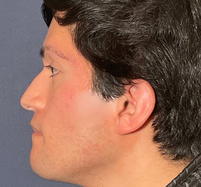  Liquid Rhinoplasty Before & After Gallery - Patient 145833089 - Image 1