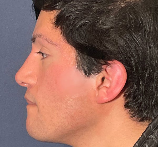  Liquid Rhinoplasty Before & After Gallery - Patient 145833089 - Image 2