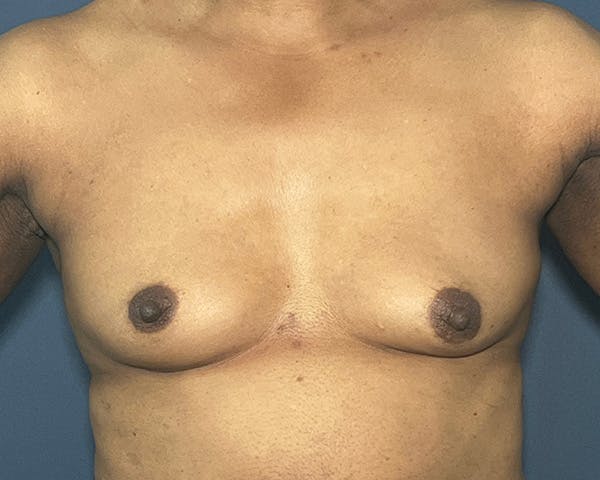 Breast Augmentation Before & After Gallery - Patient 146131560 - Image 1