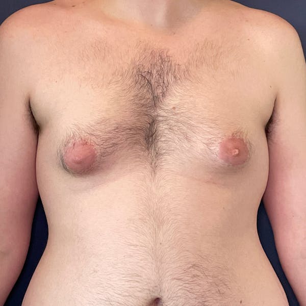 Gynecomastia (Male Breast Reduction) Before & After Gallery - Patient 146362408 - Image 1