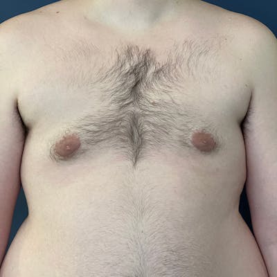 Gynecomastia (Male Breast Reduction) Before & After Gallery - Patient 146362408 - Image 2