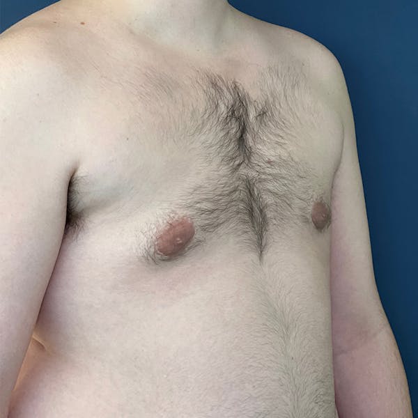Gynecomastia (Male Breast Reduction) Before & After Gallery - Patient 146362408 - Image 4
