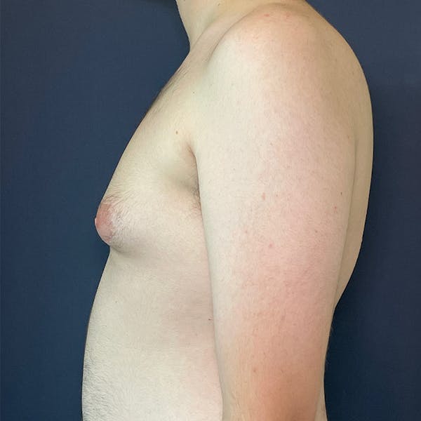 Gynecomastia (Male Breast Reduction) Before & After Gallery - Patient 146362408 - Image 5