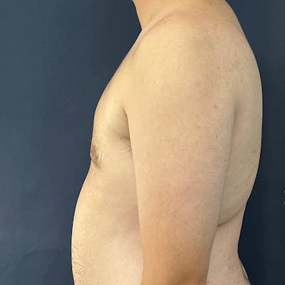 Gynecomastia (Male Breast Reduction) Before & After Gallery - Patient 146362408 - Image 6