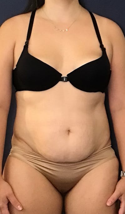 Coolsculpting Before & After Gallery - Patient 147667902 - Image 1