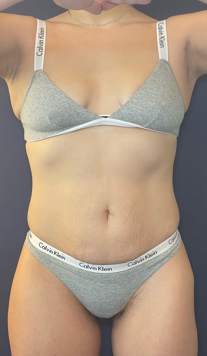 Coolsculpting Before & After Gallery - Patient 147667902 - Image 2