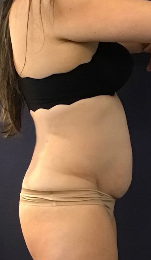 Coolsculpting Before & After Gallery - Patient 147667902 - Image 3