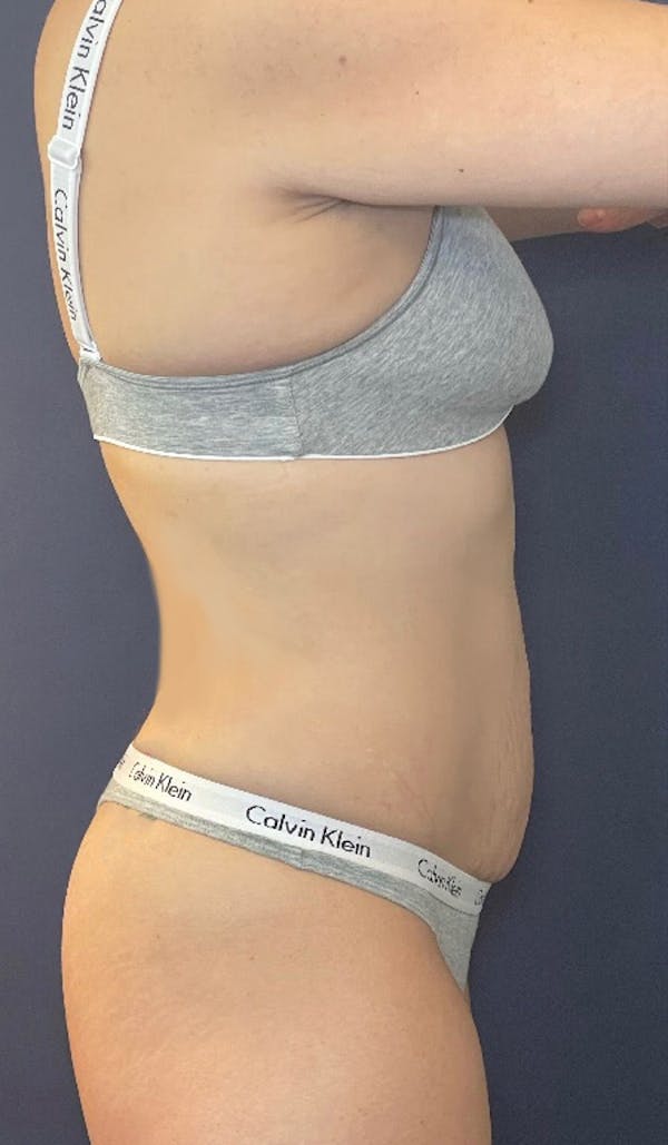 Coolsculpting Before & After Gallery - Patient 147667902 - Image 4