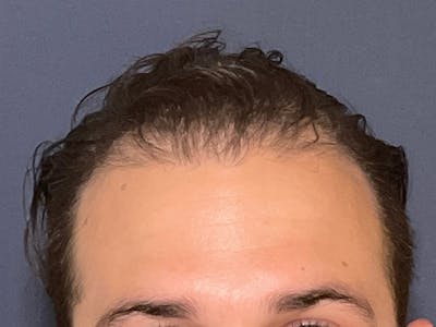 Neograft Before & After Gallery - Patient 147739183 - Image 1