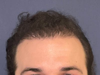 Neograft Before & After Gallery - Patient 147739183 - Image 2