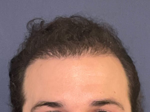 Neograft Before & After Gallery - Patient 147739183 - Image 2
