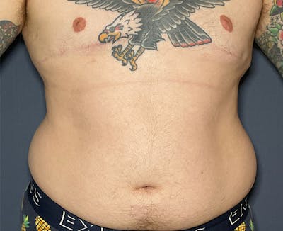 Tummy Tuck (Abdominoplasty) Before & After Gallery - Patient 148148024 - Image 1
