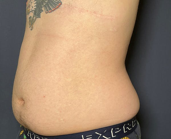 Liposuction Before & After Gallery - Patient 148148023 - Image 3