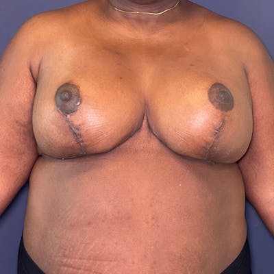 NaturaBra® Mastopexy Before & After Gallery - Patient 148163277 - Image 2