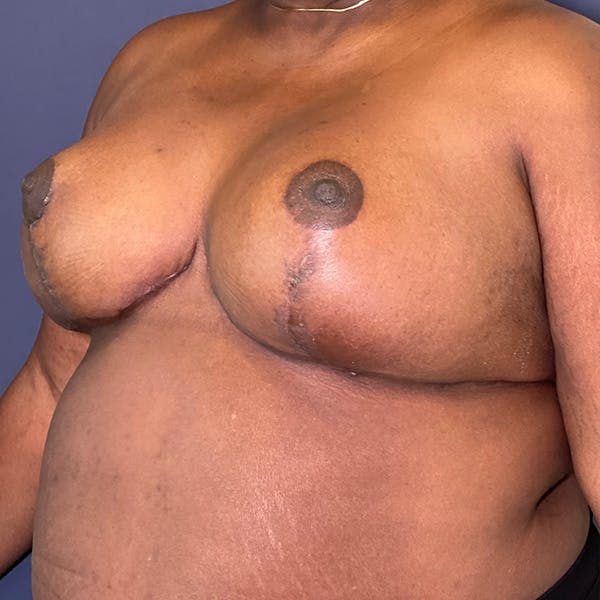 Breast Reduction Before & After Gallery - Patient 148148126 - Image 4