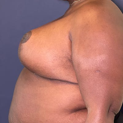 NaturaBra® Mastopexy Before & After Gallery - Patient 148163277 - Image 6