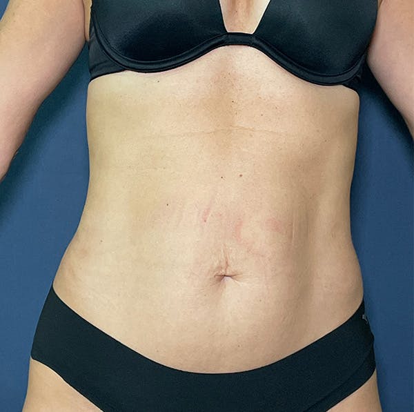 Tummy Tuck (Abdominoplasty) Before & After Gallery - Patient 148257627 - Image 1