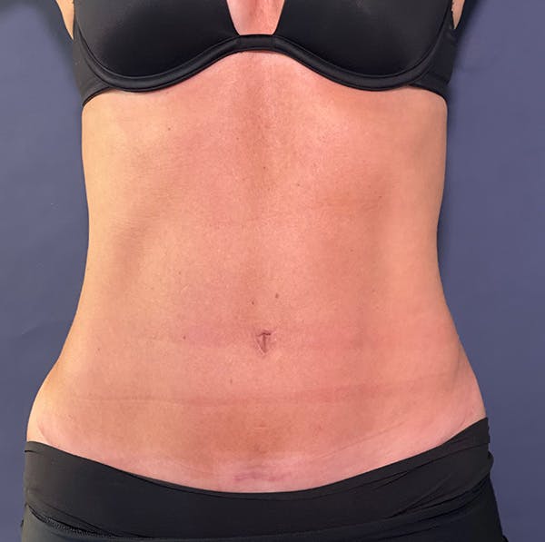 Tummy Tuck (Abdominoplasty) Before & After Gallery - Patient 148257627 - Image 2