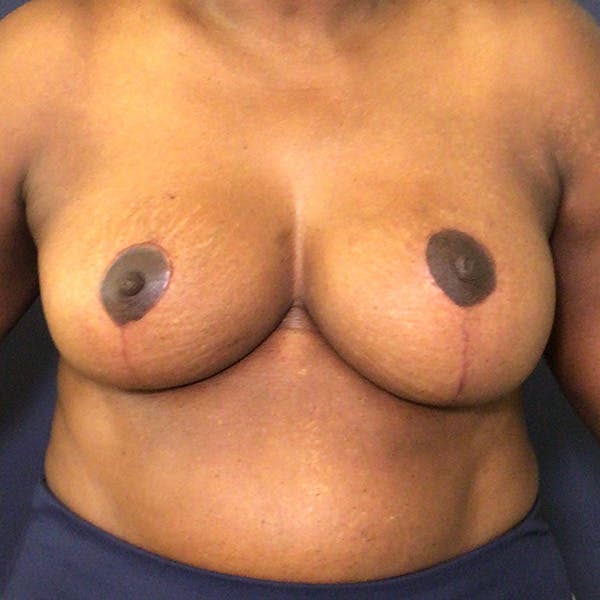NaturaBra® Mastopexy Before & After Gallery - Patient 148702988 - Image 2