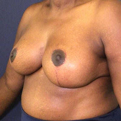 NaturaBra® Mastopexy Before & After Gallery - Patient 148702988 - Image 4