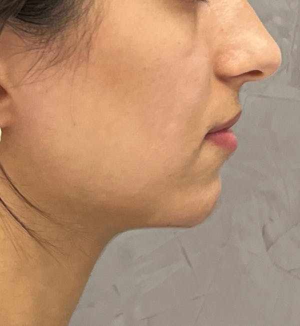 Dermal Fillers Before & After Gallery - Patient 149097492 - Image 1