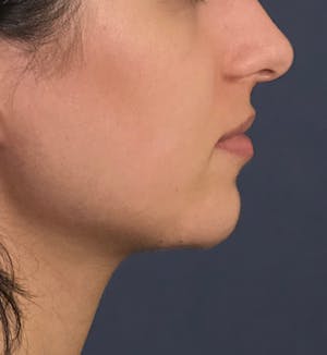 Before and After Dermal Fillers in Long Island