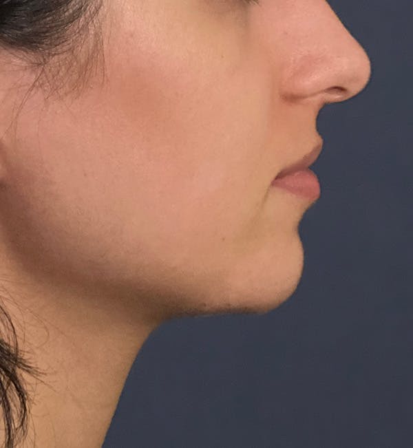 Dermal Fillers Before & After Gallery - Patient 149097492 - Image 2