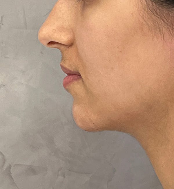 Dermal Fillers Before & After Gallery - Patient 149097492 - Image 3