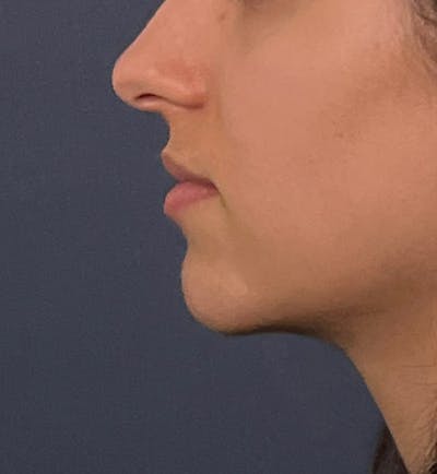 Dermal Fillers Before & After Gallery - Patient 149097492 - Image 4