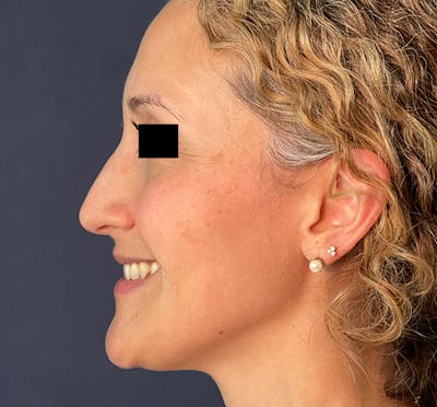  Liquid Rhinoplasty Before & After Gallery - Patient 149097840 - Image 1