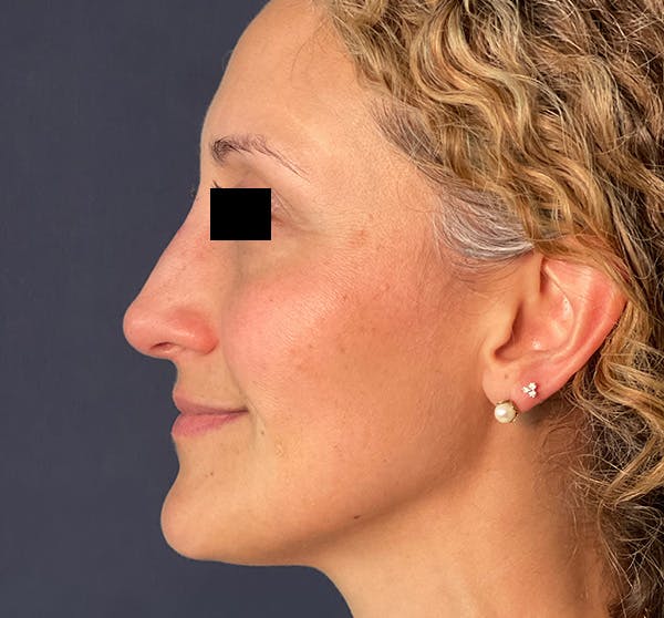 Patient 5 After Non-Surgical Rhinoplasty