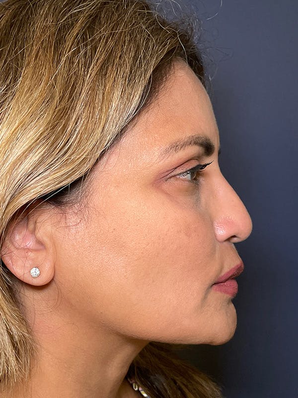 Dermal Fillers Before & After Gallery - Patient 149097707 - Image 5