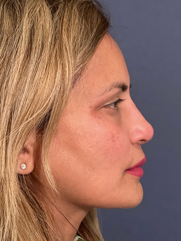  Liquid Rhinoplasty Before & After Gallery - Patient 149120120 - Image 4