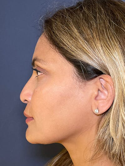  Liquid Rhinoplasty Before & After Gallery - Patient 149120120 - Image 1