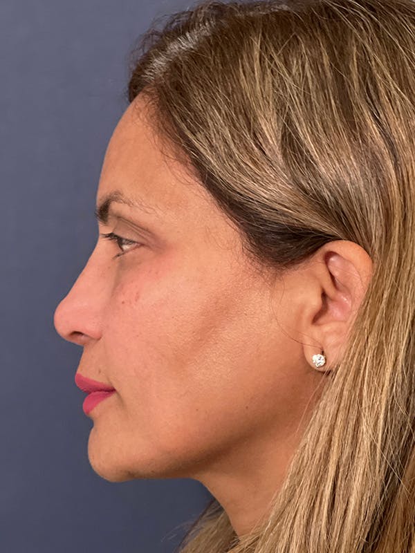  Liquid Rhinoplasty Before & After Gallery - Patient 149120120 - Image 2