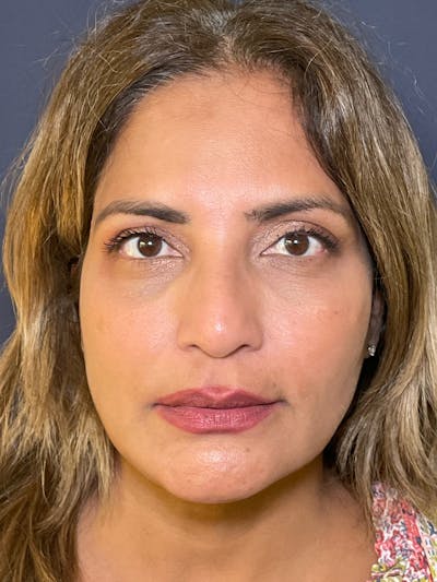 Dermal Fillers Before & After Gallery - Patient 149097707 - Image 1