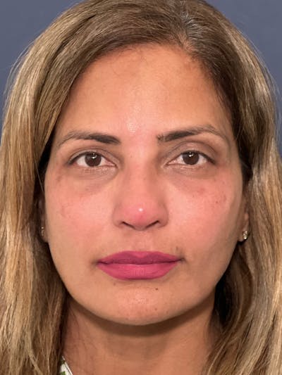 Liquid Rhinoplasty Before & After Gallery - Patient 149120120 - Image 6