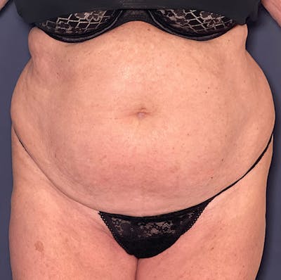 Liposuction Before & After Gallery - Patient 149259317 - Image 1