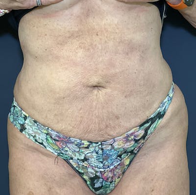 Liposuction Before & After Gallery - Patient 149259317 - Image 2