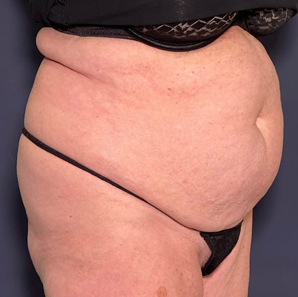 Liposuction Before & After Gallery - Patient 149259317 - Image 3