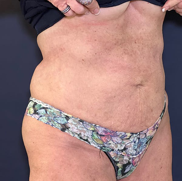 Liposuction Before & After Gallery - Patient 149259317 - Image 4