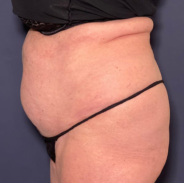 Liposuction Before & After Gallery - Patient 149259317 - Image 5