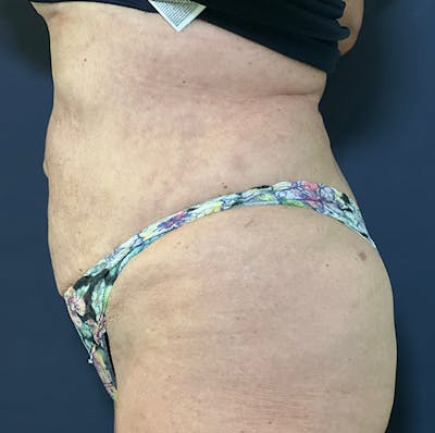 Liposuction Before & After Gallery - Patient 149259317 - Image 6