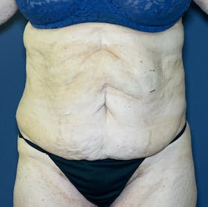 Tummy Tuck Before and After Images