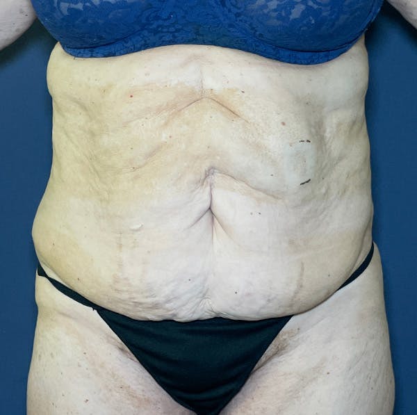 Tummy Tuck (Abdominoplasty) Before & After Gallery - Patient 155774734 - Image 1