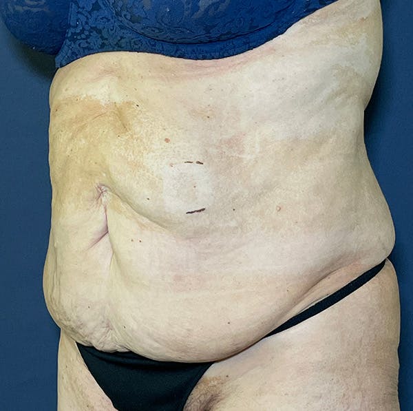 Tummy Tuck (Abdominoplasty) Before & After Gallery - Patient 155774734 - Image 3
