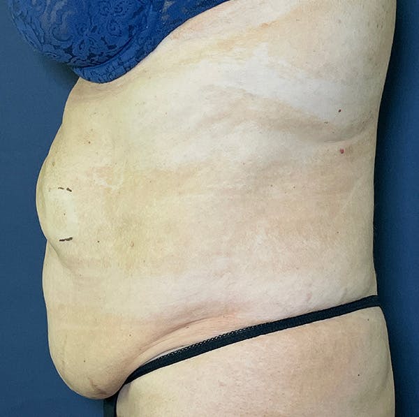 Tummy Tuck (Abdominoplasty) Before & After Gallery - Patient 155774734 - Image 5